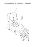 Methods and Devices for Endoscopic Access to the Heart diagram and image