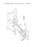 Methods and Devices for Endoscopic Access to the Heart diagram and image