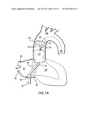 Methods and Devices for Endoscopic Access to the Heart diagram and image