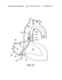Methods and Devices for Endoscopic Access to the Heart diagram and image
