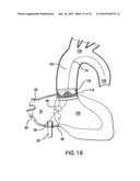 Methods and Devices for Endoscopic Access to the Heart diagram and image