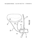 Methods and Devices for Endoscopic Access to the Heart diagram and image