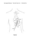 Methods and Devices for Endoscopic Access to the Heart diagram and image