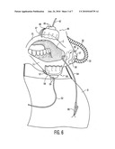 Magnetic surgical retractor diagram and image