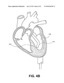 ELECTRODE DATA ANALYSIS TO INDICATE CATHETER STABILITY AND/OR NEEDLE PENETRATION SUCCESS diagram and image