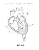 ELECTRODE DATA ANALYSIS TO INDICATE CATHETER STABILITY AND/OR NEEDLE PENETRATION SUCCESS diagram and image