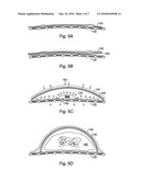 BIOLOGICAL TISSUE GROWTH THROUGH INDUCED TENSILE STRESS diagram and image