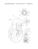 IMPLANTATION OF REPAIR CHORDS IN THE HEART diagram and image