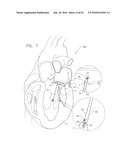 IMPLANTATION OF REPAIR CHORDS IN THE HEART diagram and image