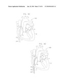 IMPLANTATION OF REPAIR CHORDS IN THE HEART diagram and image