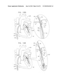 IMPLANTATION OF REPAIR CHORDS IN THE HEART diagram and image