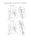 IMPLANTATION OF REPAIR CHORDS IN THE HEART diagram and image