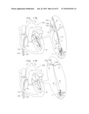 IMPLANTATION OF REPAIR CHORDS IN THE HEART diagram and image