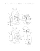 IMPLANTATION OF REPAIR CHORDS IN THE HEART diagram and image