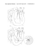 IMPLANTATION OF REPAIR CHORDS IN THE HEART diagram and image