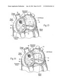 Devices, systems, and methods for reshaping a heart valve annulus diagram and image
