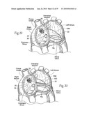 Devices, systems, and methods for reshaping a heart valve annulus diagram and image
