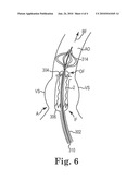 EXPANDABLE PROSTHETIC VALVE HAVING ANCHORING APPENDAGES diagram and image