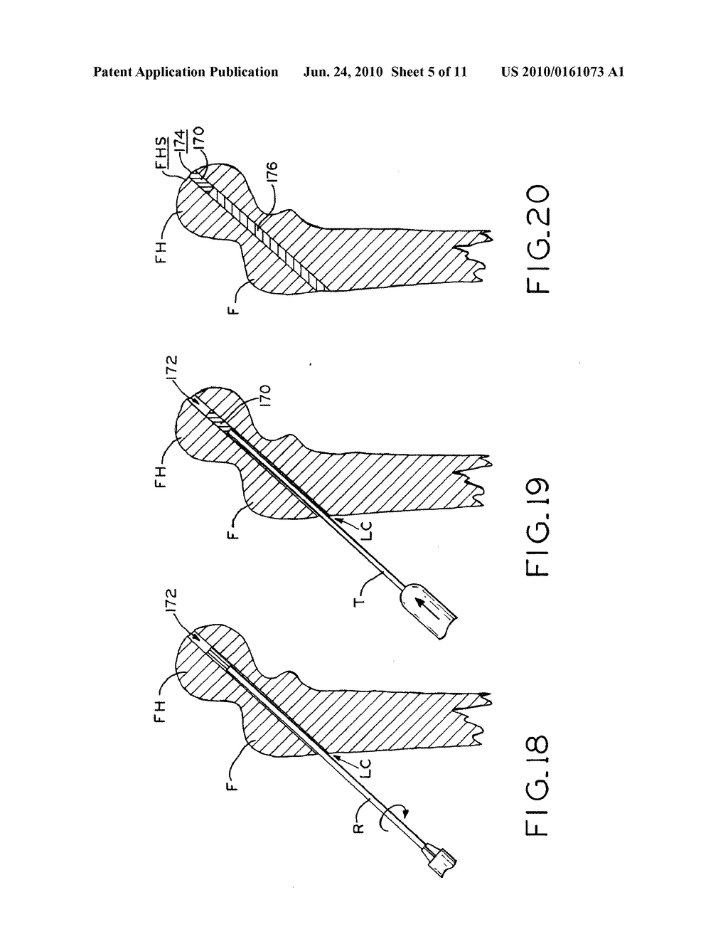 MOSAICPLASTY CONSTRUCTS - diagram, schematic, and image 06