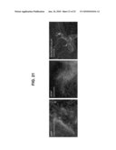 Multi-stage stem cell carcinogenesis diagram and image