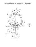 ORTHOVOLTAGE RADIOTHERAPY diagram and image