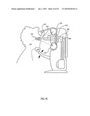 ORTHOVOLTAGE RADIOTHERAPY diagram and image