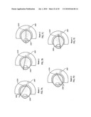 ORTHOVOLTAGE RADIOTHERAPY diagram and image