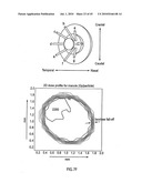 ORTHOVOLTAGE RADIOTHERAPY diagram and image