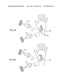 ORTHOVOLTAGE RADIOTHERAPY diagram and image