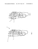 Bunion reliever and method of treatment diagram and image