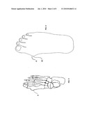 Bunion reliever and method of treatment diagram and image