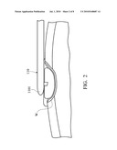 WOUND TREATMENT APPARATUS AND GUIDING UNIT THEREOF diagram and image