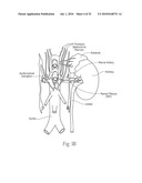 APPARATUS, SYSTEMS, AND METHODS FOR ACHIEVING INTRAVASCULAR, THERMALLY-INDUCED RENAL NEUROMODULATION diagram and image