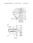 APPARATUS, SYSTEMS, AND METHODS FOR ACHIEVING INTRAVASCULAR, THERMALLY-INDUCED RENAL NEUROMODULATION diagram and image