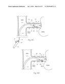 APPARATUS, SYSTEMS, AND METHODS FOR ACHIEVING INTRAVASCULAR, THERMALLY-INDUCED RENAL NEUROMODULATION diagram and image