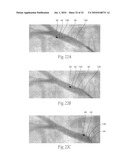 APPARATUS, SYSTEMS, AND METHODS FOR ACHIEVING INTRAVASCULAR, THERMALLY-INDUCED RENAL NEUROMODULATION diagram and image