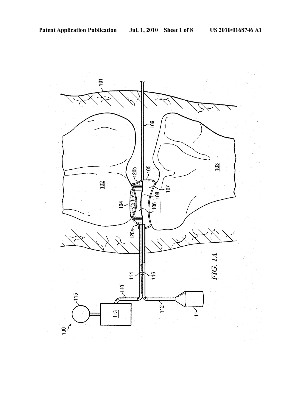 REDUCED PRESSURE AUGMENTATION OF MICROFRACTURE PROCEDURES FOR CARTILAGE REPAIR - diagram, schematic, and image 02