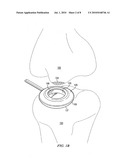 REDUCED PRESSURE AUGMENTATION OF MICROFRACTURE PROCEDURES FOR CARTILAGE REPAIR diagram and image
