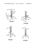 INTRAGASTRIC BALLOON RETRIEVAL MECHANISMS diagram and image