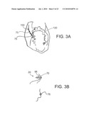 SYSTEMS AND METHODS FOR CLOSING A HOLE IN CARDIAC TISSUE diagram and image