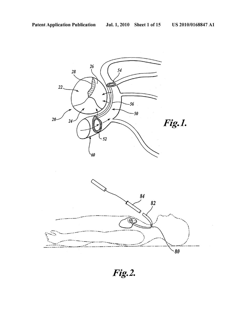 Device and Method for Modifying the Shape of a Body Organ - diagram, schematic, and image 02