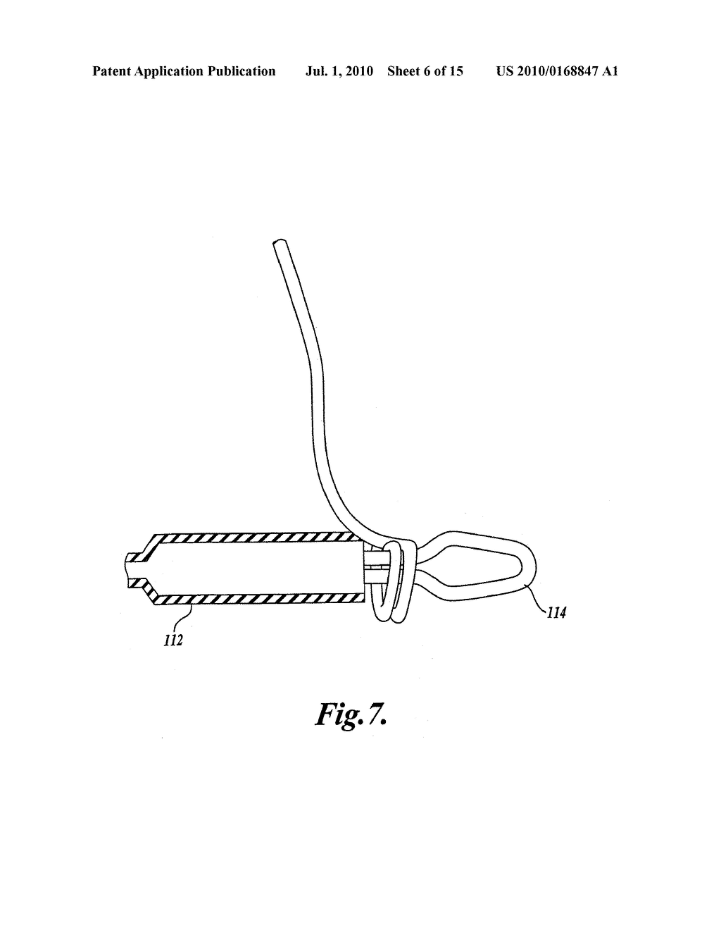 Device and Method for Modifying the Shape of a Body Organ - diagram, schematic, and image 07