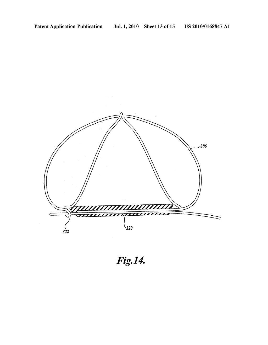 Device and Method for Modifying the Shape of a Body Organ - diagram, schematic, and image 14