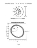 OCULAR RADIOSURGERY diagram and image