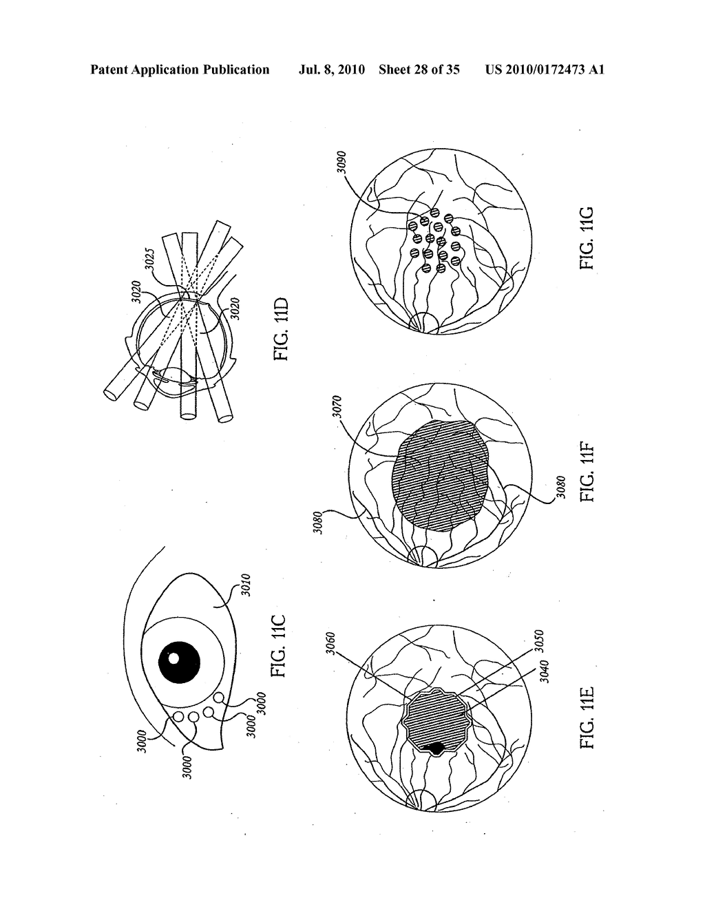 OCULAR RADIOSURGERY - diagram, schematic, and image 29