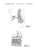 ANCHOR HAVING FILL PORT FOR USE WITH AN IMPLANTABLE THERAPY DELIVERY ELEMENT diagram and image
