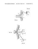 Ostomy Appliance diagram and image