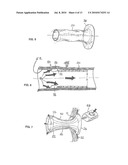 Ostomy Appliance diagram and image