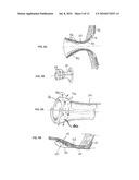 Ostomy Appliance diagram and image