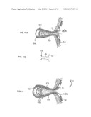 Ostomy Appliance diagram and image